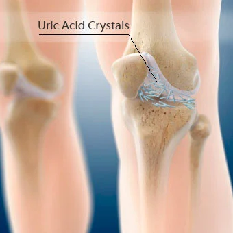 Uric acid crystals in the joints cause gouty arthritis.